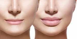 Lip fillers