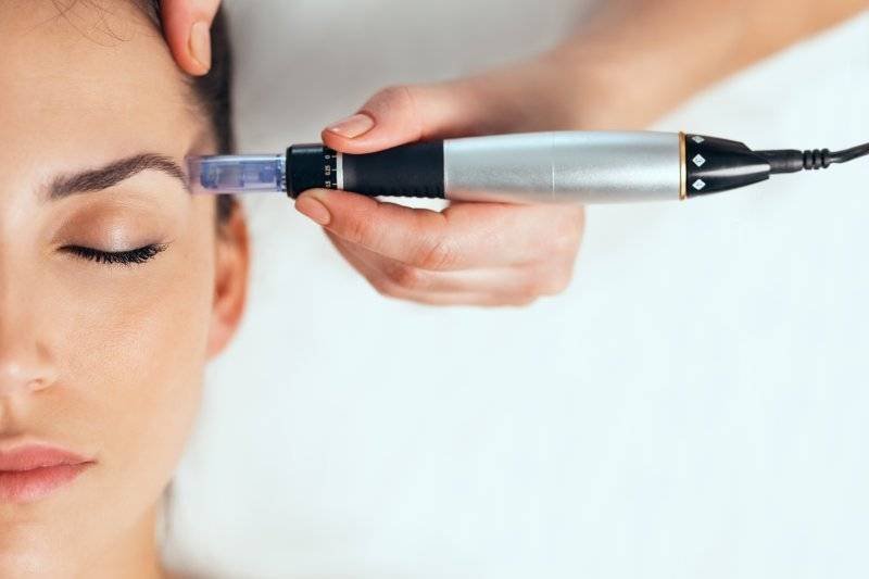 What Is Microneedling? Benefits, Process, Safety, and Results Explained