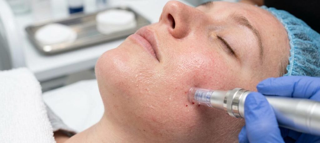 What Is Microneedling and What Benefits Does It Provide Your Skin?